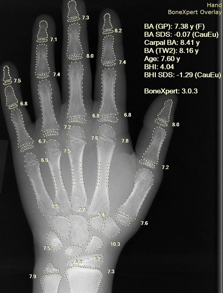 A computer program automatically determines the age of a person's hand bones through an X-ray examination.